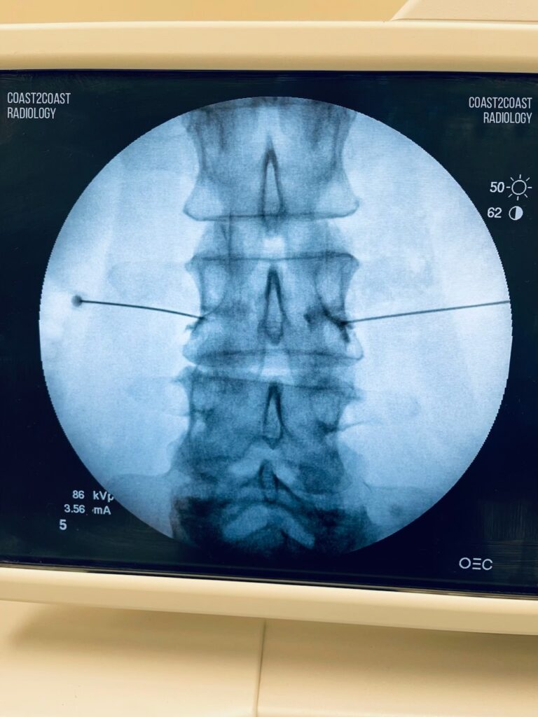 Fluoroscopy monitor screen displaying a spine X-ray procedure By Coast To Coast Radiology
